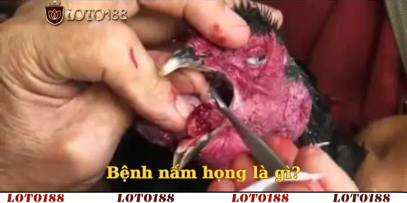 Bệnh nấm họng là gì?